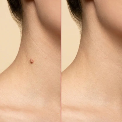 SOLUBLE MICRONEEDLE BOTANICAL SKIN TAG REMOVAL PATCH