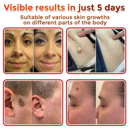 SOLUBLE MICRONEEDLE BOTANICAL SKIN TAG REMOVAL PATCH
